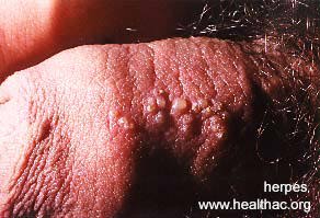 herpes picture