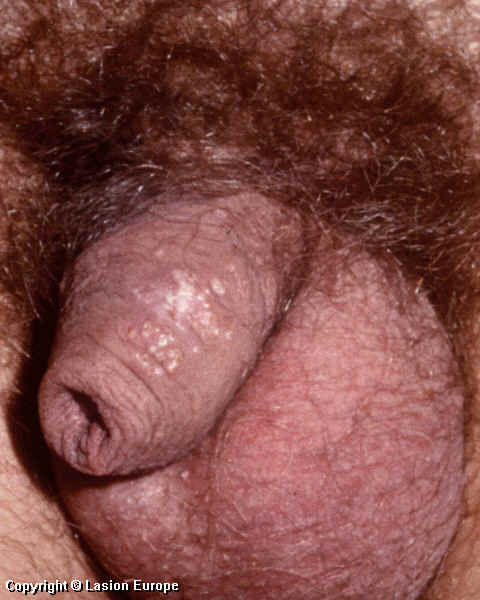 herpes picture